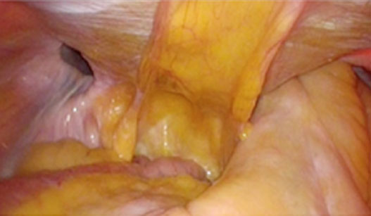 両側そけいヘルニアの症例です。左にはヘルニアの入り口が見えています。右は腸管が陥入している状態です。