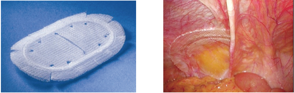 左図はKugel法で⽤いる⾮吸収性のパッチです。右図は腹腔内から観察した写真です。