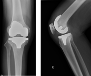 図2a 術後膝関節単純X線